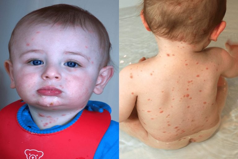 الجديرى أو جدرى الماء