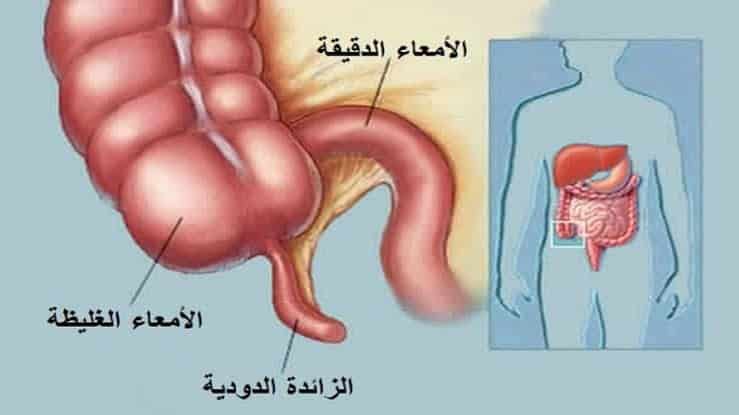 التهاب الزائدة الدودية