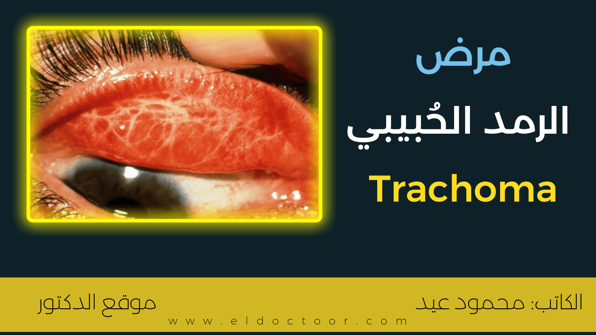 الرمد الحُبيبي (التراكوما - Trachoma) | الأسباب والعلاج