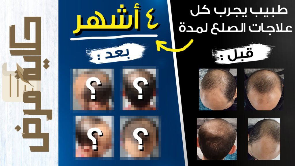 ما تحتاج معرفته عن أدوية وعلاجات الصلع الوراثي