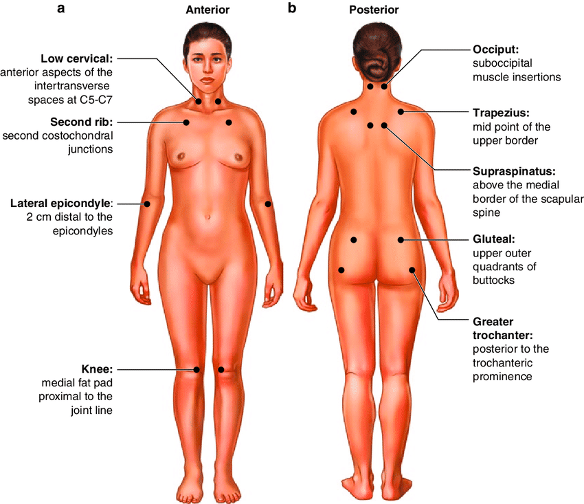 أماكن توزيع النقاط المؤلمة في الجسم كيفية تشخيص الألم العضلي الليفي (fibromyalgia) من خلال تحديد النقاط المؤلمة (tender points)