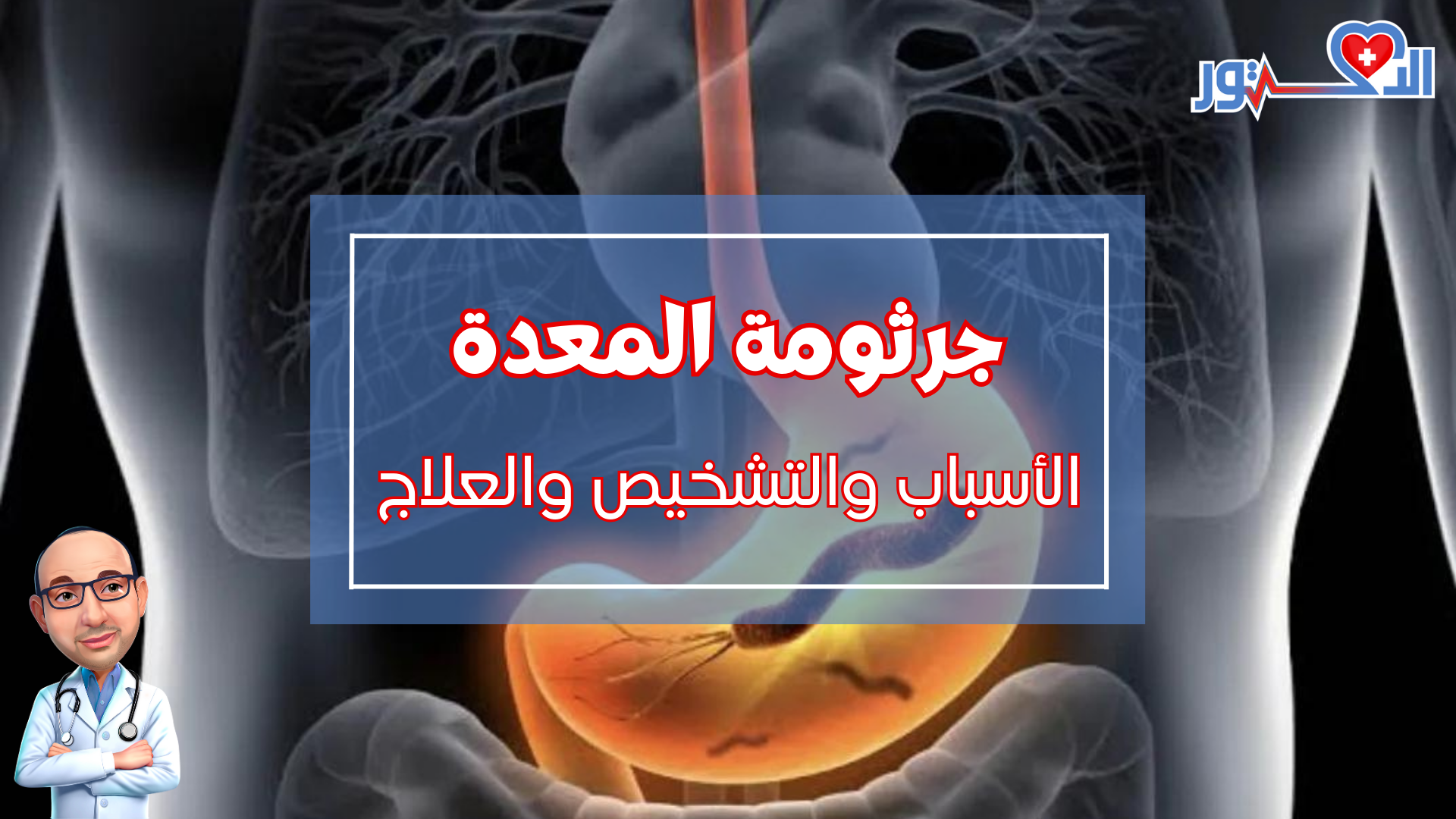 جرثومة المعدة الاسباب والتشخيص والعلاج